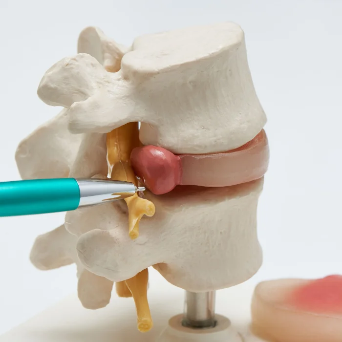 Disc Injury