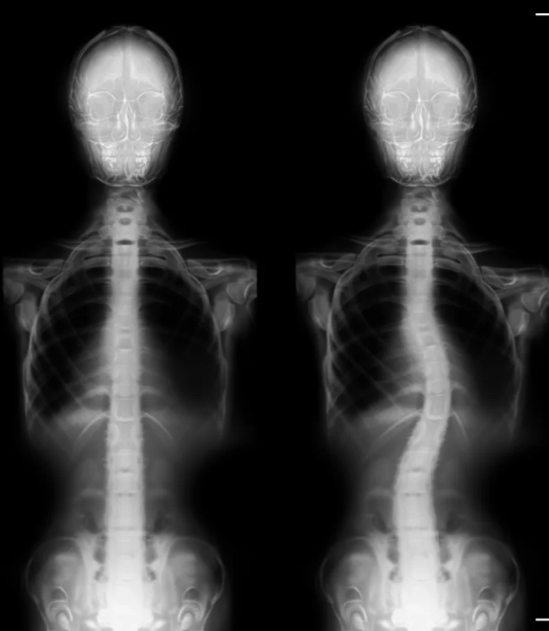 Scoliosis Batavia